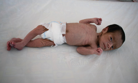 Malnourished baby rescued from small village